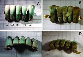 Una protesi dentale di quattro secoli fa